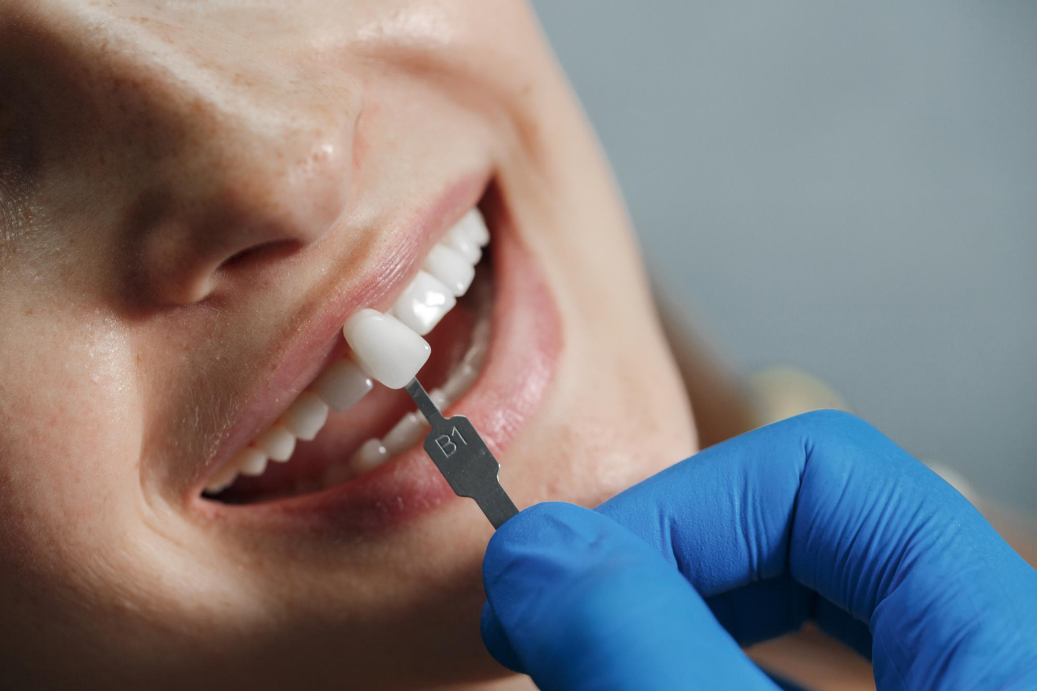 Implantes con poco hueso en Barcelona | Clínica Cotten