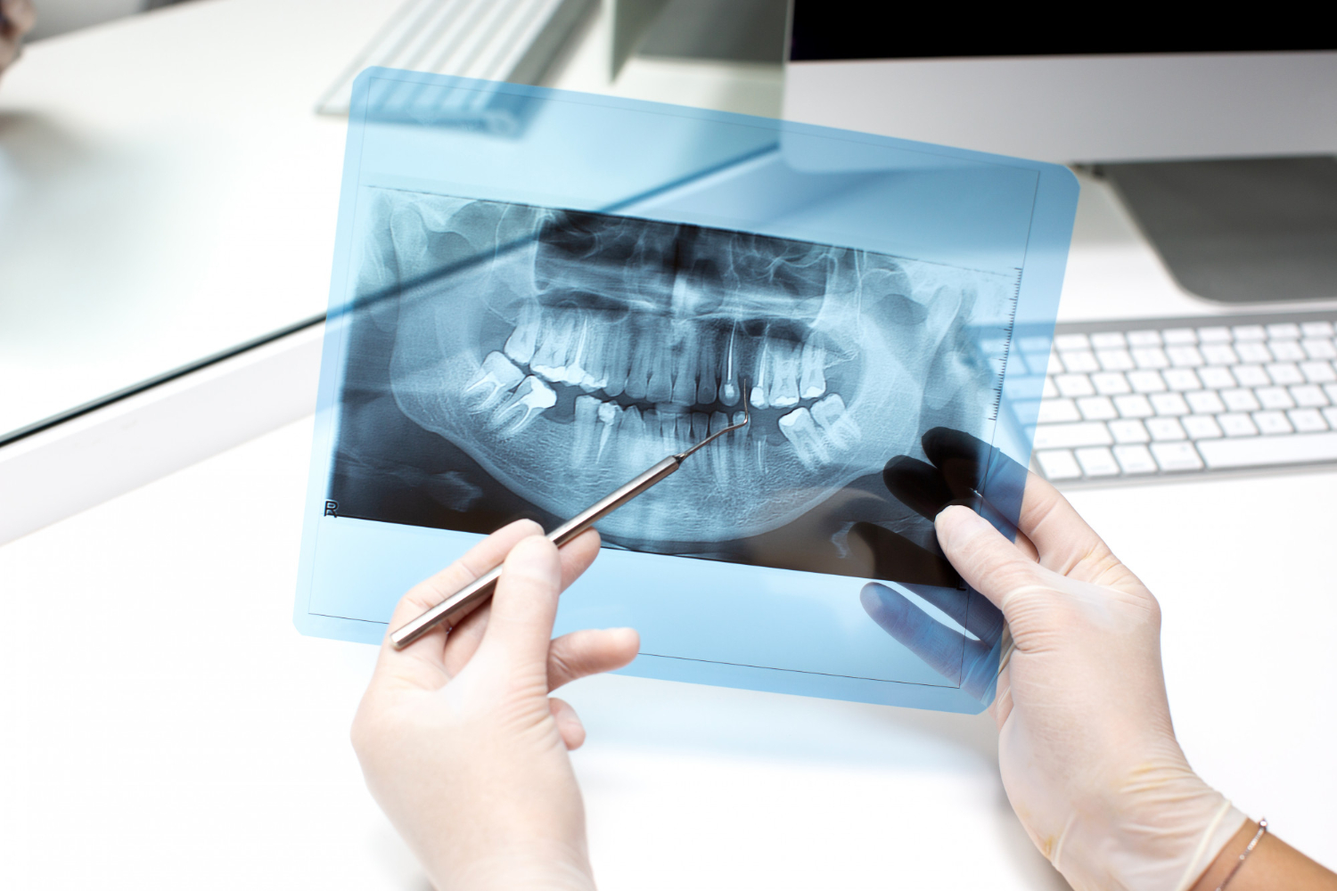 Injerto de hueso dental: opiniones y alternativas reales